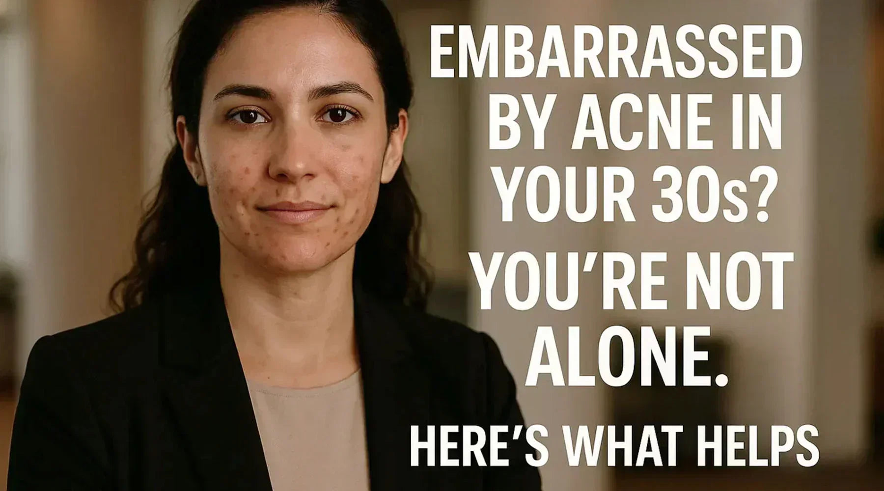 Woman with acne and text: "Embarrassed by acne in your 30s? You’re not alone. Here’s what helps."