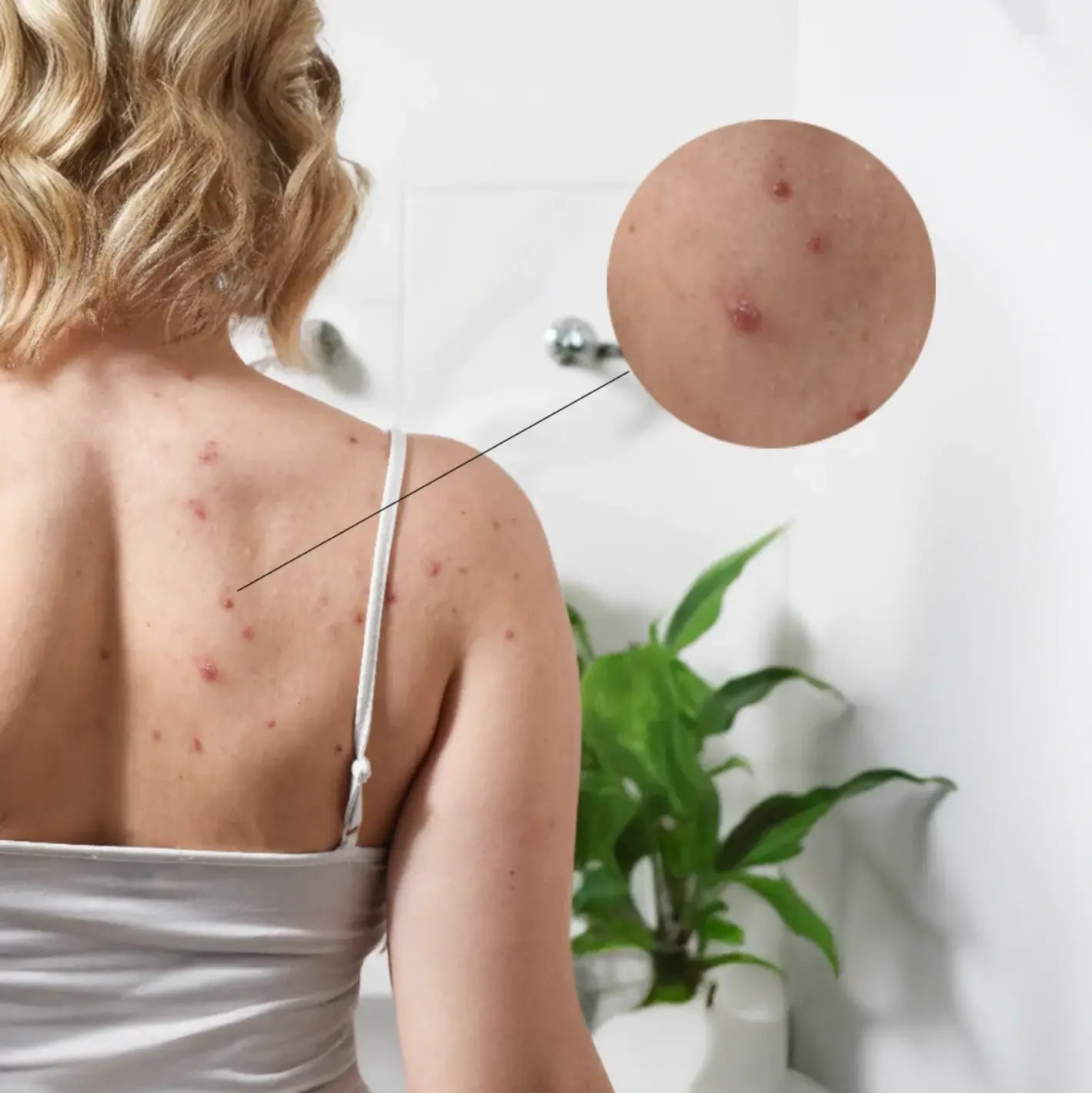 Back Acne