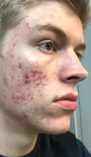 Before - Day 1